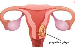 چگونه شایع‌ترین نوع سرطان در میان زنان را از بین ببریم؟