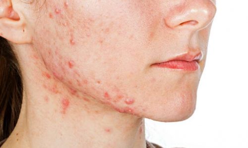 برای درمان آکنه چه کنیم؟