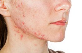 برای درمان آکنه چه کنیم؟