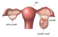 کیست تخمدان؛ از دلایل ناباروری در زنان