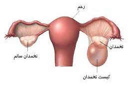 کیست تخمدان؛ از دلایل ناباروری در زنان